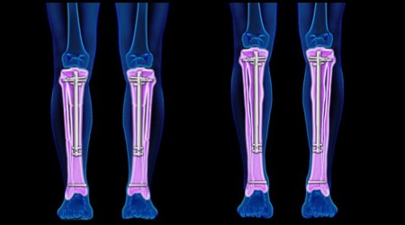 BILATERAL TIBIA LENGTHENING